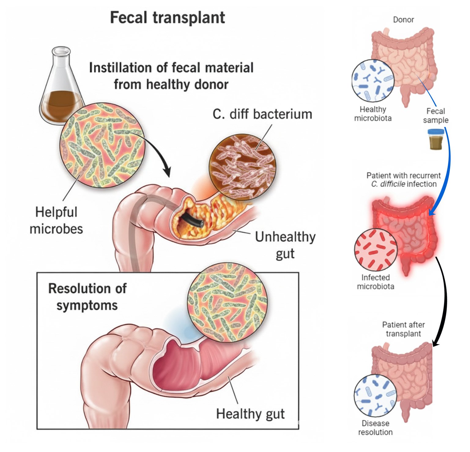 FMT Treatment for Gastrointestinal Diseases - Clostridioides difficile, IBS, SIBO, Ulcerative Colitis, Crohn's Disease